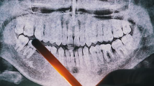 Dental X-Ray of Jaw with Teeth. Sealed Molars. Dentist Examines the Dental Arch