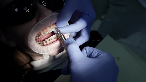 A Patient with a Mouth Dilator in a Dental Chair Braces on His Teeth a Doctor Performs Various