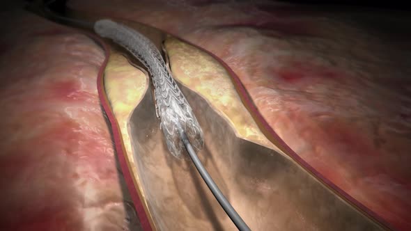 Hemoglobin cells flowing through a blocked Artery causing arteriosclerosis disease.