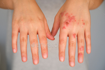 Patient hands with and without eczema comparison.