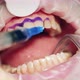Close Up of Dental Medicine Getting Applied Onto Patient's Teeth - VideoHive Item for Sale