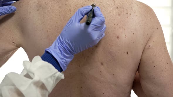 Dermatologist Examines the Patient's Moles and Marks the Ones to Be Removed