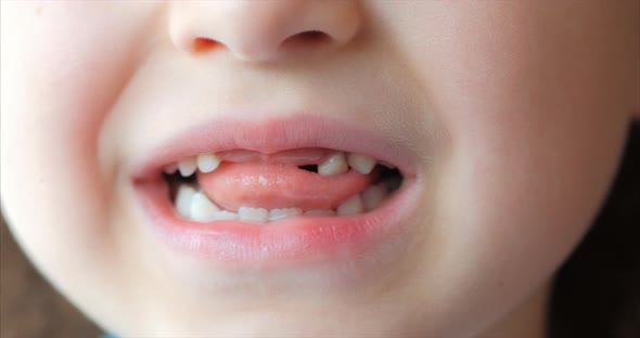 Close-up of a Little Girl's smile, Baby Teeth. Child Shakes His Tongue Milk Tooth.