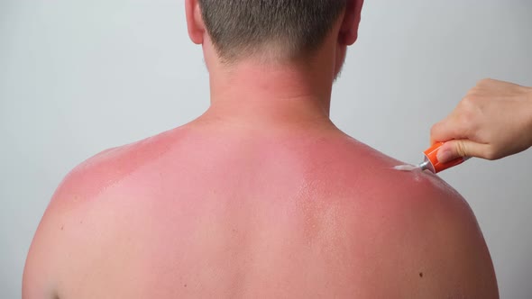 Applying Therapeutic Ointment to the Skin of a Person with a Sunburn Closeup