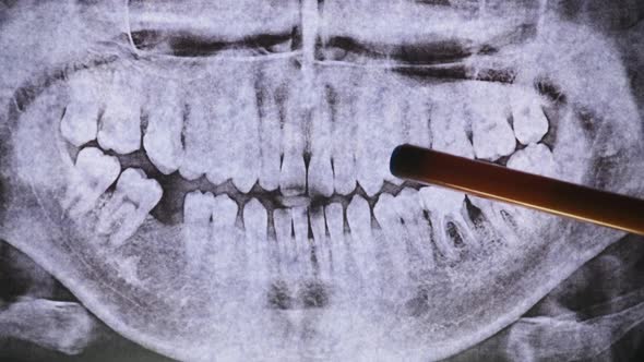 Dental XRay of Jaw with Teeth