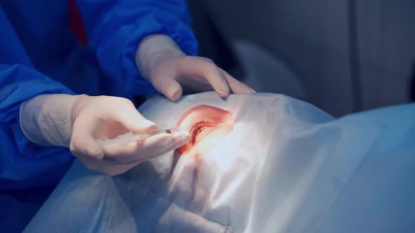 Patient under sterile cover. Close up detail of a surgery of the eye