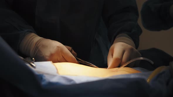 Close Up of a Surgeon's Hand Suturing a Wound After a Successful Operation