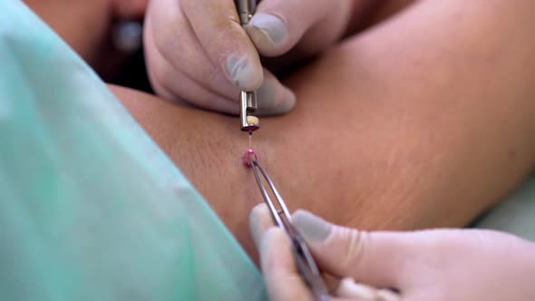 Closeup Beautician Removing Big Mole From Woman's Armpit with Laser Lying on Table in Medical Center