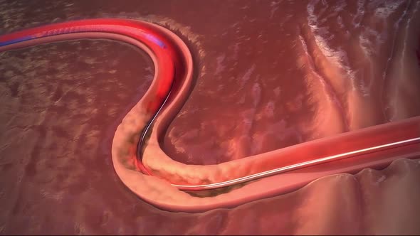 Stent Angioplasty Procedure 3d medical