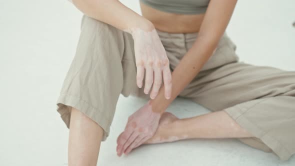 Pretty Young Woman with Vitiligo Pigmentation Sitting on the White Floor Looking at the Camera