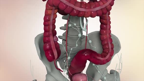 3D Medical animation of colon cancer. Tumor growth