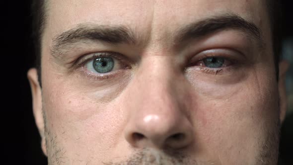 Close Up of Man with Severe Bloodshot Red Blood Eye Affected By Conjunctivitis