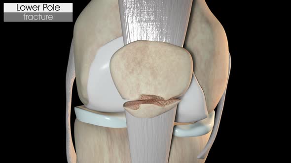 Patella Fracture   Lower Pole