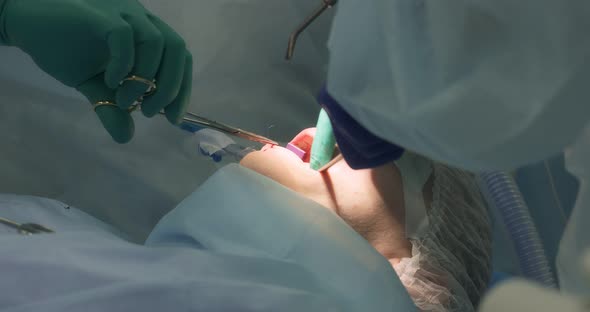 The Surgeon Applies a Suture After Removing Wisdom Teeth to the Patient