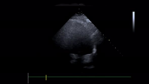 Ultrasound Machine with Monitor Examination of the Heart