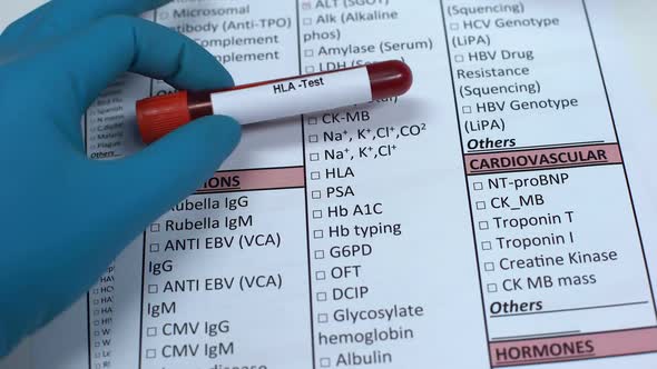 HLA, Doctor Checking Antigene Name in Lab Blank, Showing Blood Sample in Tube