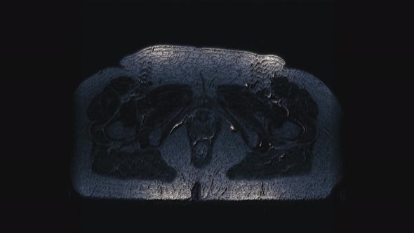 Postoperative Voluminous Color MRI of Female Organs for the Detection of Metastases
