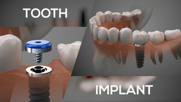 Implant On1 Concept
