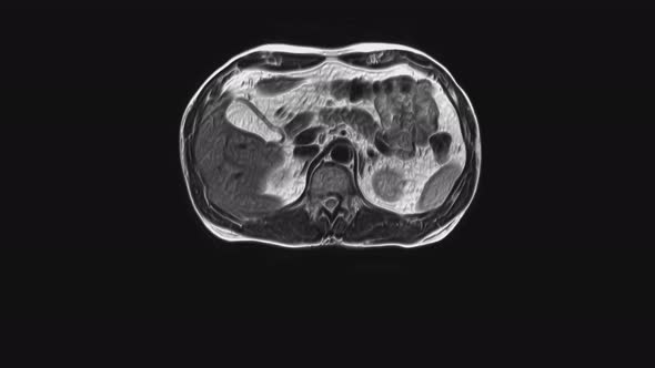 Voluminous CT Scan of the Abdomen