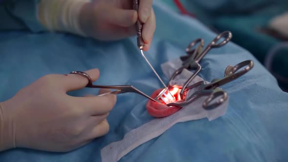 Surgeons Are Installing Inner Hearing Aid Into Ear of Patient Under General Anesthesia, Close-up