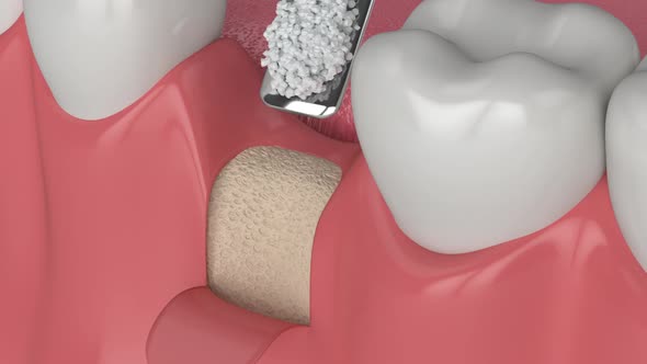 3d dental bone grafting and bone augmentation procedure