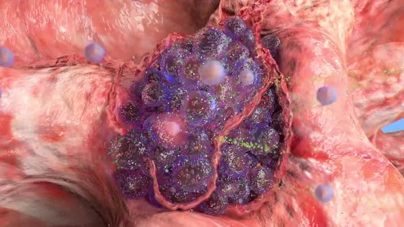 Stages of Tumor Development. 3D Medical animated video