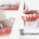 Premolar tooth restoration - VideoHive Item for Sale