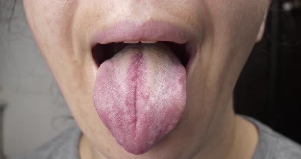 Oral Disease White Coating on the Tongue Woman Tongue Cancer
