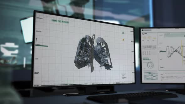 Special medical program analyzes covid-19 pneumonia damage in human lungs alt