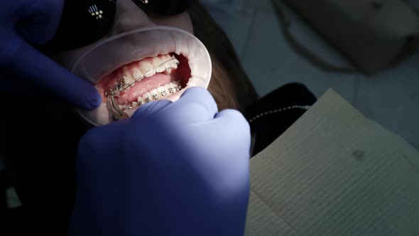 Orthodontic Specialist Is Fixing Dental Braces on Teeth of Female Patient in Clinic Closeup View