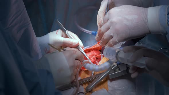 Closeup of Professional Doctor Hands Operating a Patient During Open Heart Surgery in Surgical Room