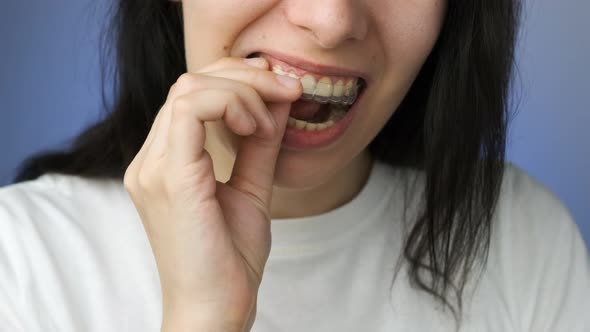 Woman Easily Inserts and Removes Invisible Transparent Aligner From the Upper Jaw