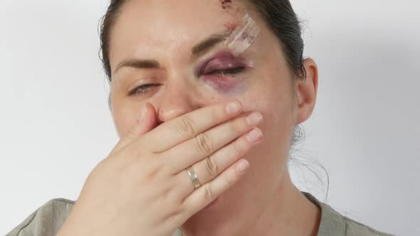 Young Woman Yawns at the Camera with Real Bruise Hematoma Under Eye of a Young Woman Fresh Purple