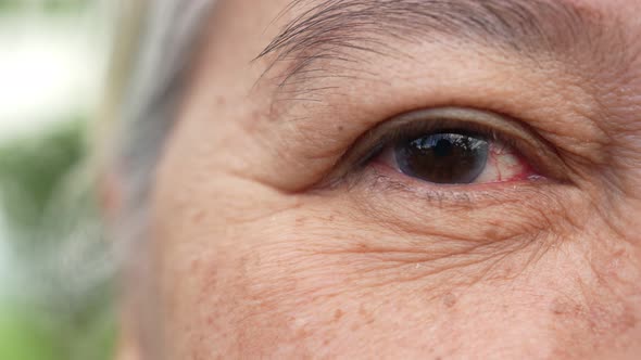 Close up of the senile cataract during eye examination. A white cloudy disc is seen in black eye cir