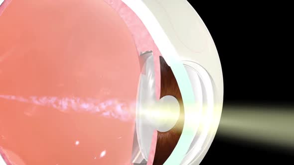 Anatomy of the Eye. Loss of vision in the eye