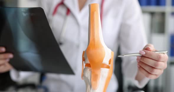 Doctor Holds Xray of Leg with Osteoarthritis or Arthrosis of Mock Leg