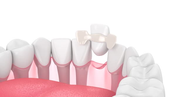 Lower jaw with dental maryland bridge placement