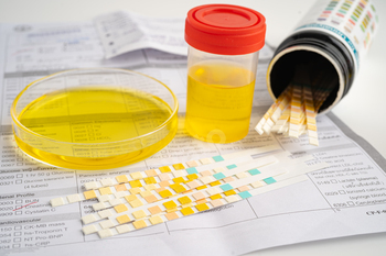 Urinalysis, urine cup with reagent strip pH paper test and comparison chart in laboratory.