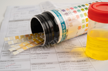 Urinalysis, urine cup with reagent strip pH paper test and comparison chart in laboratory.