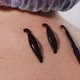 Three Leeches on Patient's Neck Closeup - VideoHive Item for Sale