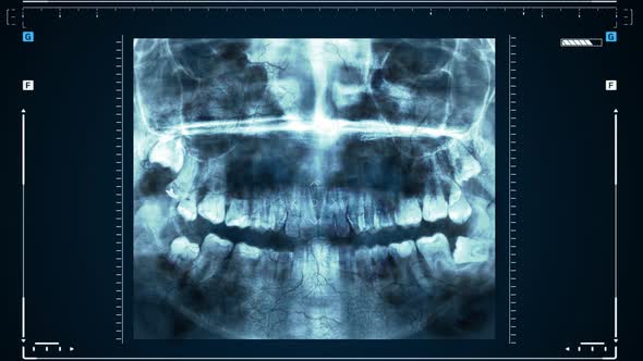 Xray of Human Teeth or Research on Dental Health