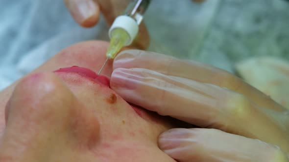 The Cosmetologist Makes Injections on the Client's Face in the Lip Area