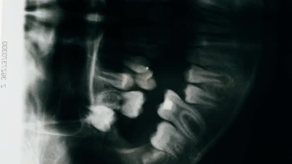 Jaw Xray Closeup