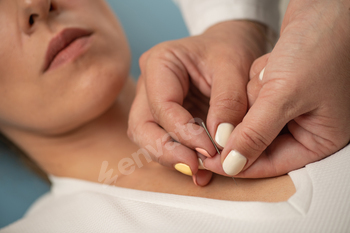 Acupuncture treatment for managing anxiety