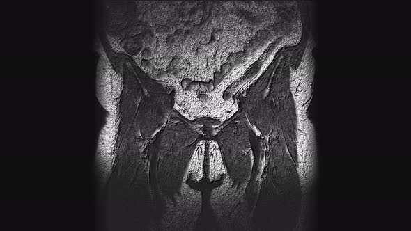 Postoperative Voluminous MRI of Female Organs for the Detection of Metastases