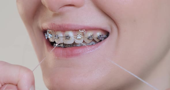 Woman Cleaning Teeth in Braces with Dental Floss Closeup