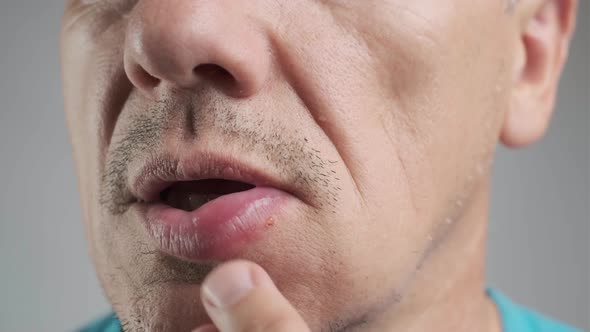 Allergic Reaction on a Man's Lip After a Bee Sting