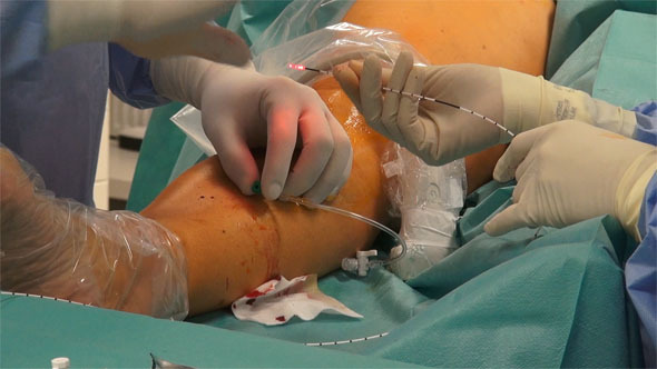Laser Surgery for Varicose Veins