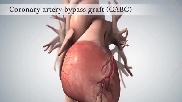 Coronary artery bypass surgery is done using a healthy blood vessel called a graft.