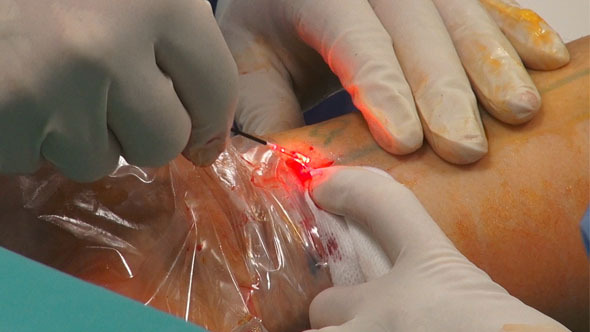 Laser Surgery- Removed From The Vein Laser